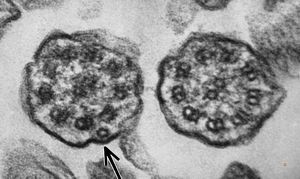 F,5y. | immotile cilia syndrome - trachea